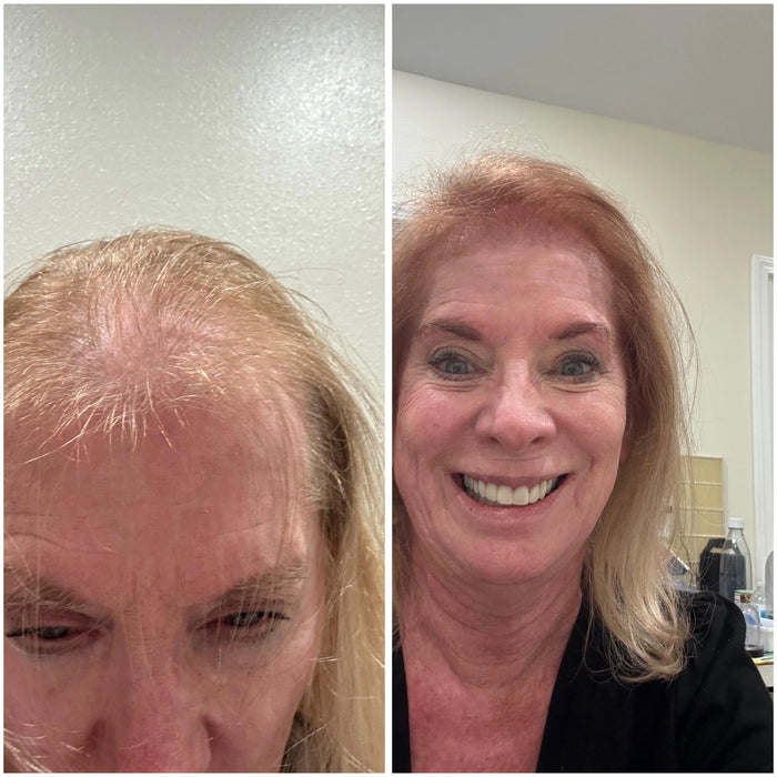 No hormones, derm-approved